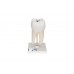 model ludzkiego dolnego trzonowca z ubytkami - 1000243 [d10/4] 3b scientific modele anatomiczne 3